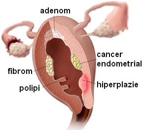 endometrioza